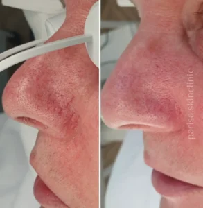 Couperose behandeling,Vaatlaserbehandeling