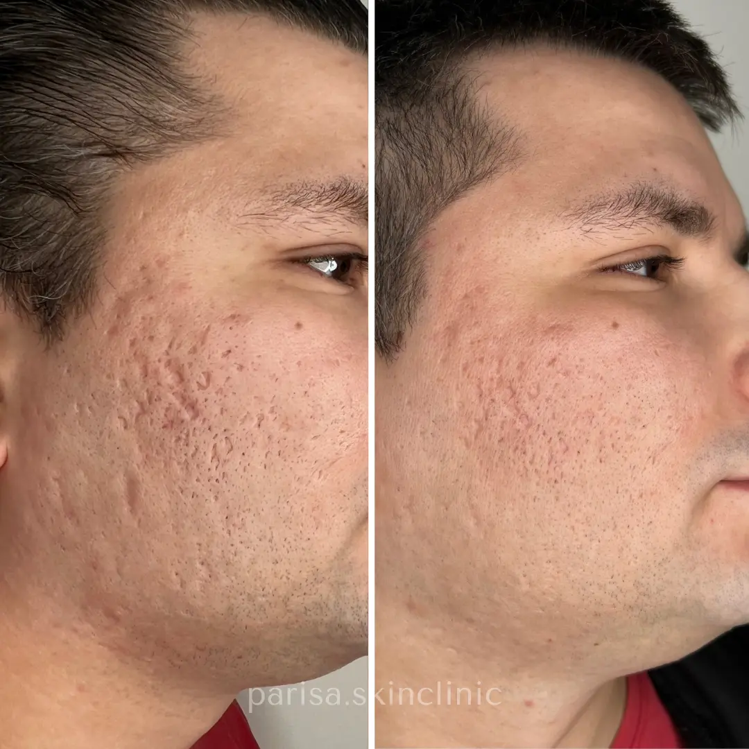 Acne therapy,CO2 Laser