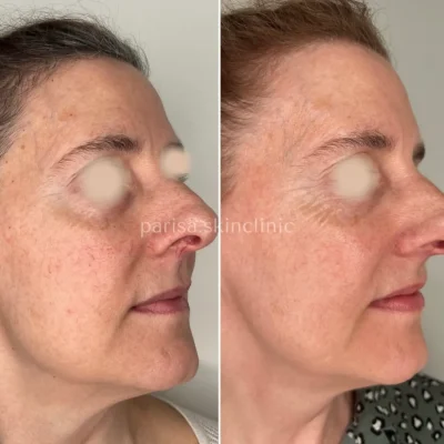 ppr-glow,IPL-photofacial